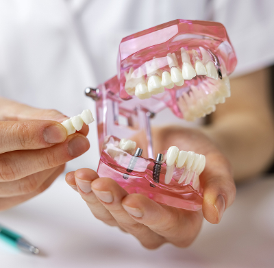 Dental implant model demonstration