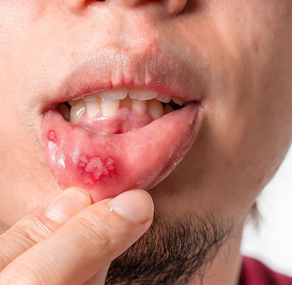 Close-up of canker sore on lip