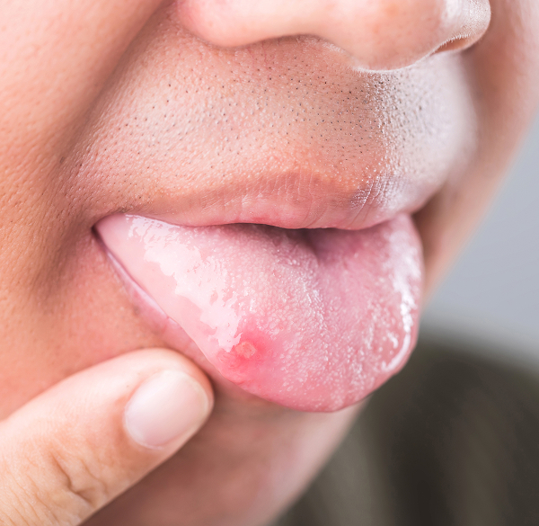 Cut on tongue close-up