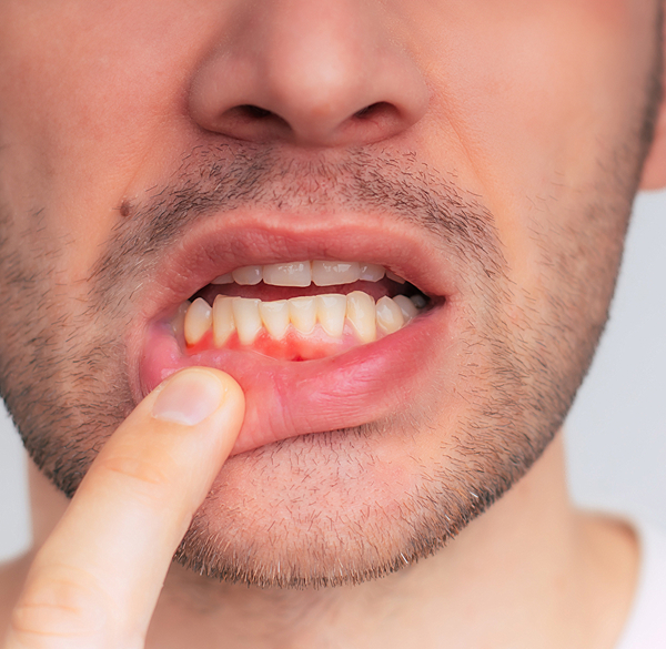 Inflamed gums showing gum disease